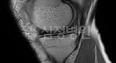 파열된 내측 반월상 연골 MRI