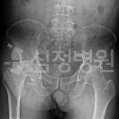 대퇴골두 무혈성 괴사증