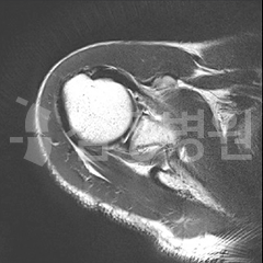 파열된 전방 관절순 MRI