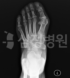 무지외반증 X-RAY : 중족골 사이가 벌어져 있음