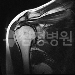 파열된 회전근육 MRI