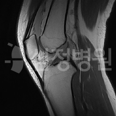 파열된 전방 십자인대 소견