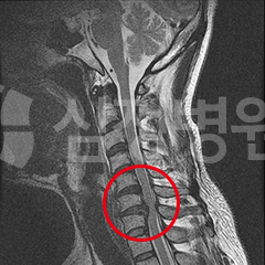 돌출된 디스크