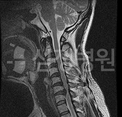 후종인대 골화증 MRI