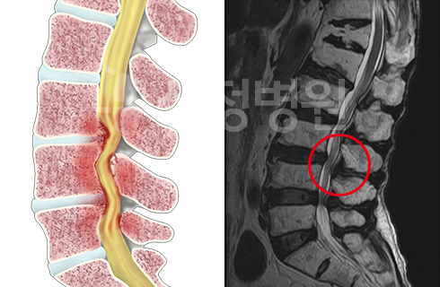 돌출된 디스크