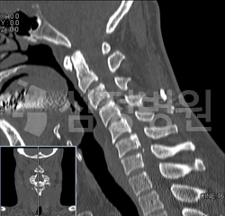 후종인대 골화증 CT